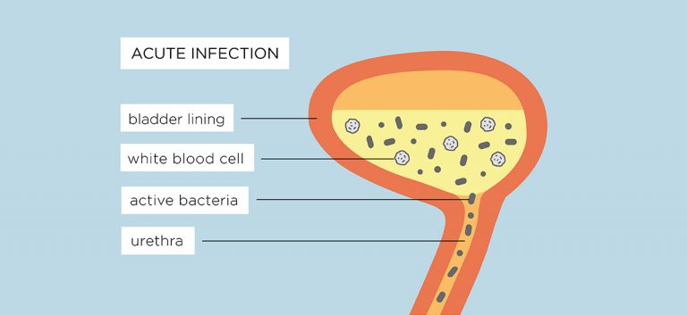 Guide to Chronic UTI - Chronic UTI Info